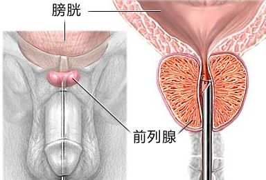 前列腺炎症狀及治療方法