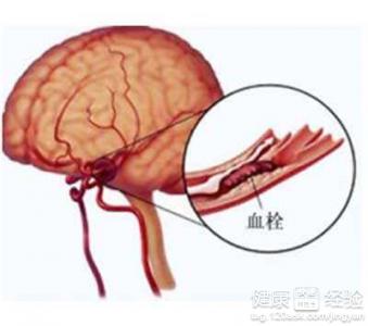 腦血栓的飲食要注意什麼?